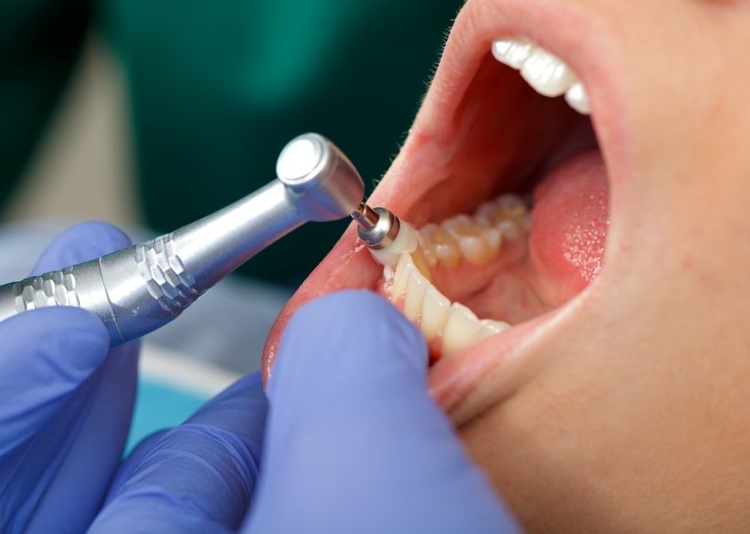 endodoncia Alicante