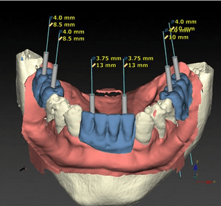 gráfica implantes en 1 hora