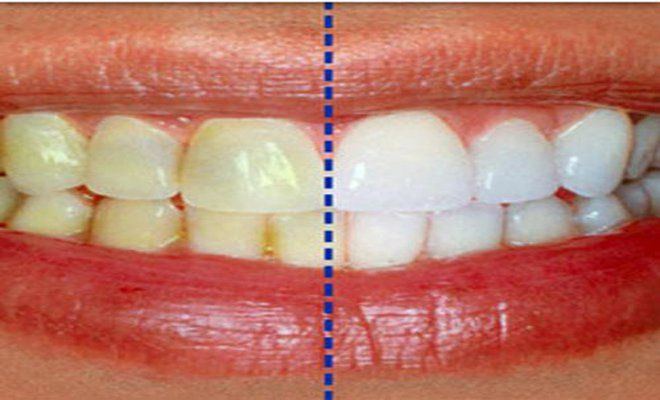 manchas en los dientes