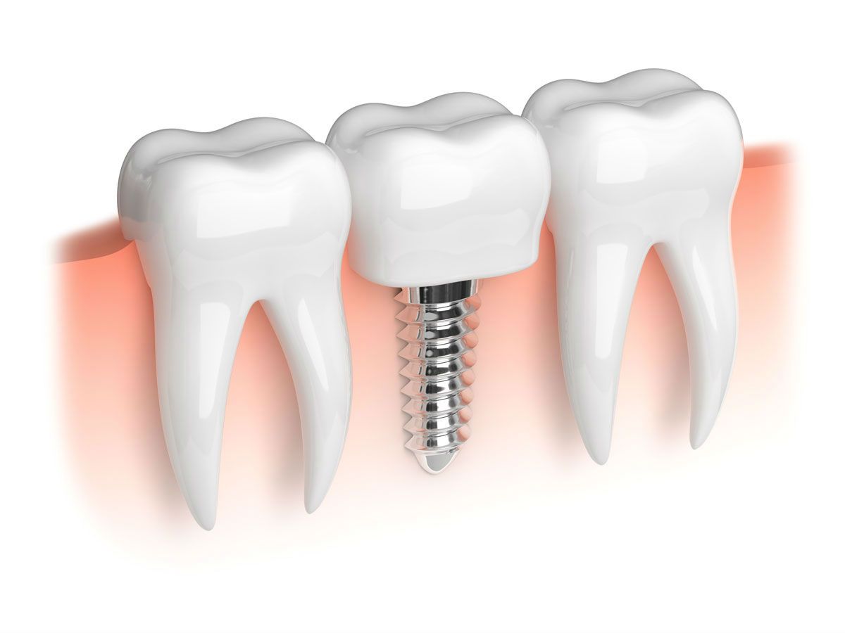 implantes