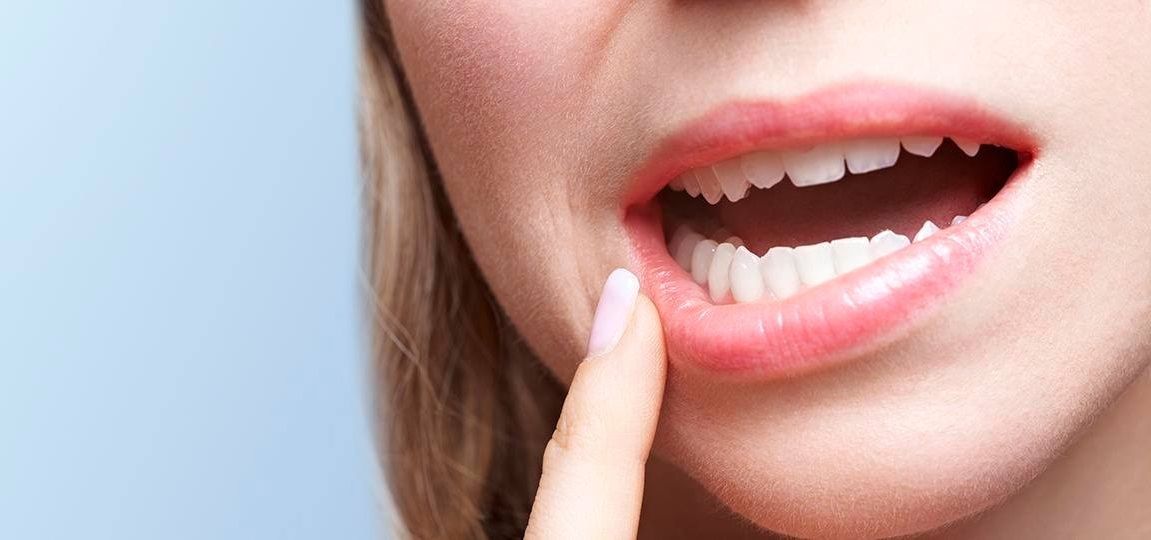Periodontitis